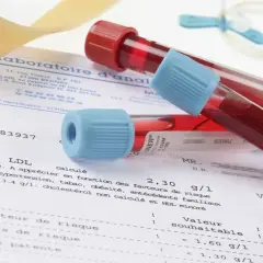 Próbki krwi w probówkach leżą na wynikach badań, gdzie widnieje m.in. "Cholestérol LDL". Badanie to pomaga ocenić ryzyko chorób serca, a jego wyniki są kluczowe, by zrozumieć, crp co to znaczy dla zdrowia.