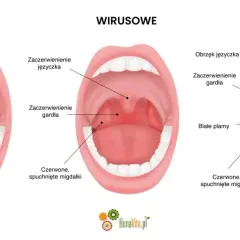 Ilustracja porównująca gardło zdrowe, zakażone wirusowo i bakteryjnie, z widocznymi migdałkami i językiem.