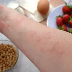 Ręka z wysypką, podejrzewane alergie krzyżowe. W tle truskawki, jajko, mleko i soja.