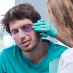 Mężczyzna z fioletowym siniakiem pod okiem, któremu pielęgniarka w zielonej rękawiczce ogląda uraz. Pytanie: co na siniaka pod okiem?