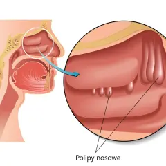 Ilustracja przekroju nosa z widocznymi polipami nosowymi.
