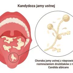 Ilustracja jamy ustnej z białymi nalotami, wskazująca na kandydozę. Powiększony fragment pokazuje drożdżaki Candida albicans, które powodują co na grzybicę jamy ustnej.