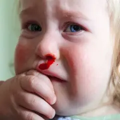 Dziecko z krwawiącym nosem.