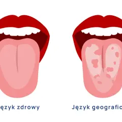 Dwa języki: zdrowy i z plamami, ilustracja porównawcza.