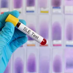 Ręka w niebieskiej rękawiczce trzyma probówkę z napisem "SLE Test", sugerującą diagnostykę tocznia. W tle widać rząd szkiełek mikroskopowych.