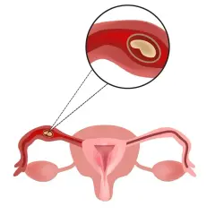 Ilustracja anatomiczna przedstawiająca ciążę pozamaciczną w jajowodzie.