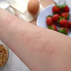 Ręka z zaczerwienionymi bąblami, objawy alergii pokarmowej. W tle truskawki, jajko i mleko.