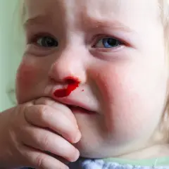 Twarz dziecka z krwawiącym nosem i zaczerwienionymi policzkami.