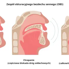Ilustracja pokazuje przekrój gardła przy normalnym oddychaniu, chrapaniu (częściowa blokada) i bezdechu sennym (OSA, całkowita blokada). Domowe sposoby na bezdech senny mogą pomóc.