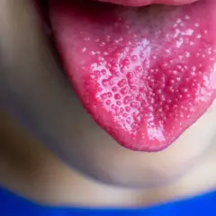 Zbliżenie na język z widocznymi czerwonymi kropkami i grudkami.