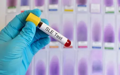 Ręka w niebieskiej rękawiczce trzyma probówkę z napisem "SLE Test", sugerującą diagnostykę tocznia. W tle widać rząd szkiełek mikroskopowych.