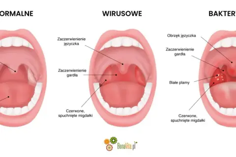 Ilustracja porównująca gardło zdrowe, zakażone wirusowo i bakteryjnie, z widocznymi migdałkami i językiem.