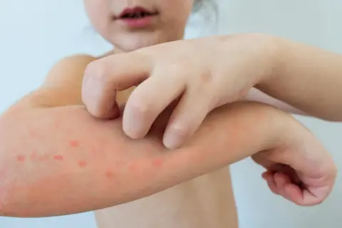 Dziecko drapie swędzące krostki na ramieniu, objawy ospy wietrznej.