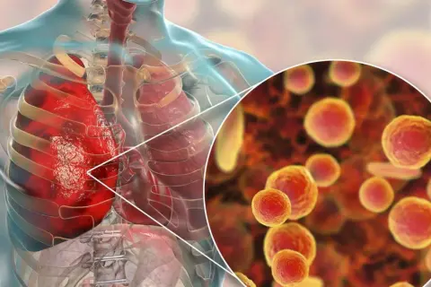 Ilustracja płuc człowieka z powiększeniem na bakterie Mycoplasma pneumoniae.