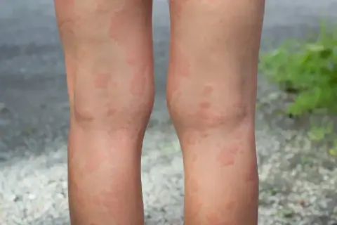 Widoczne czerwone, swędzące plamy na nogach, które mogą być objawem alergii lub pokrzywki.