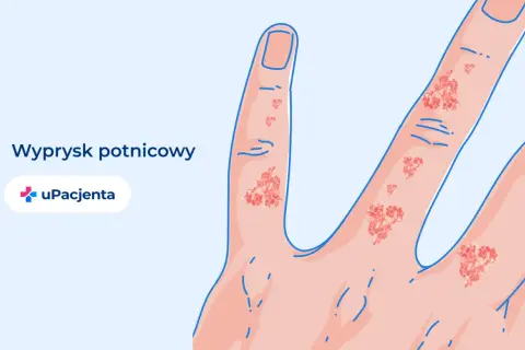 Dłoń z wypryskiem potnicowym. Czy egzema jest wyleczalna? UPacjenta.