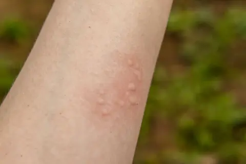 Na skórze ramienia widoczne są czerwone, wypukłe bąble, objaw pokrzywki alergicznej.