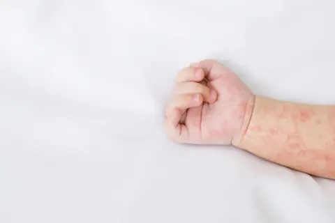 Różowa, nieswędząca wysypka u dziecka na białym tle.