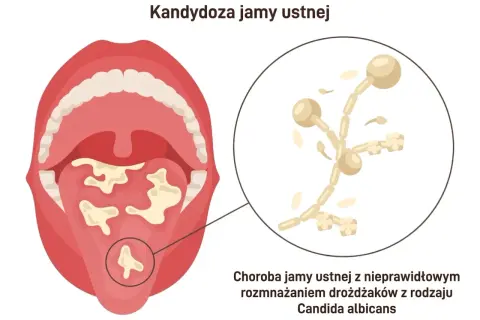 Ilustracja jamy ustnej z białymi nalotami, wskazująca na kandydozę. Powiększony fragment pokazuje drożdżaki Candida albicans, które powodują co na grzybicę jamy ustnej.