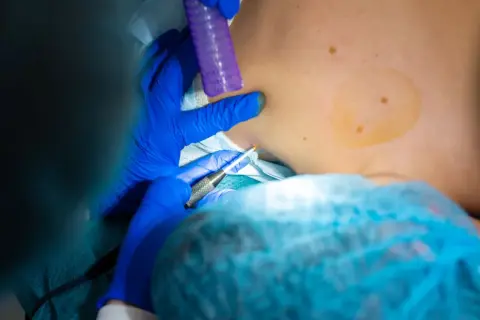 Chirurg w niebieskich rękawiczkach wykonuje biopsję skóry, pobierając próbkę do dalszych badań.