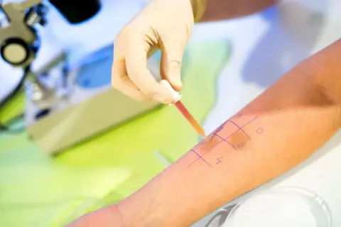 Test skórny w celu wykrycia uczulenia na wodę. Ręka pacjenta z zaznaczonymi polami do testów, na które aplikowana jest substancja.