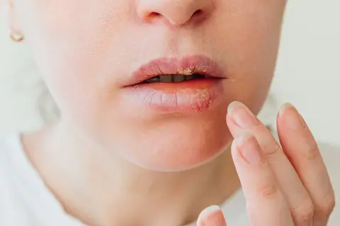Zbliżenie na usta z widocznymi wrzodami. Skóra wokół ust jest zaczerwieniona i podrażniona, a na wargach tworzą się strupy.