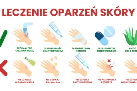 Porady co na oparzenia: chłodna woda, maść z antybiotykiem, zimny kompres, tabletki przeciwbólowe, sok z aloesu. Unikaj masła, jajka, pasty do zębów, lodu. Nie przekłuwaj pęcherzy.