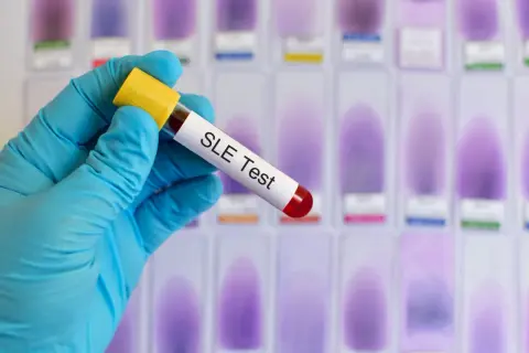 Ręka w niebieskiej rękawiczce trzyma probówkę z napisem "SLE Test", sugerującą diagnostykę tocznia. W tle widać rząd szkiełek mikroskopowych.