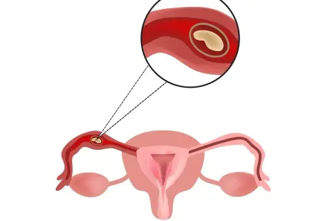 Ilustracja anatomiczna przedstawiająca ciążę pozamaciczną w jajowodzie.