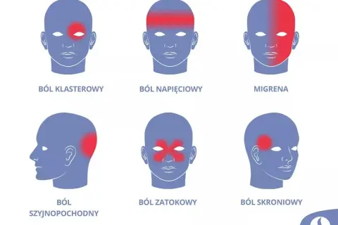 Ilustracja przedstawia sześć schematycznych głów z zaznaczonymi obszarami bólu: klastrowy, napięciowy, migrena, szyjnopochodny, zatokowy, skroniowy.