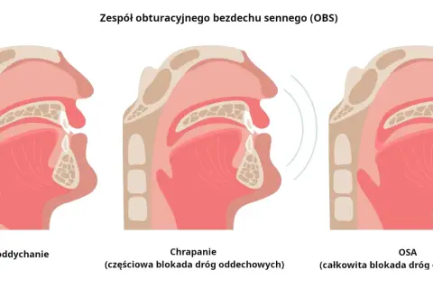 Ilustracja pokazuje przekrój gardła przy normalnym oddychaniu, chrapaniu (częściowa blokada) i bezdechu sennym (OSA, całkowita blokada). Domowe sposoby na bezdech senny mogą pomóc.