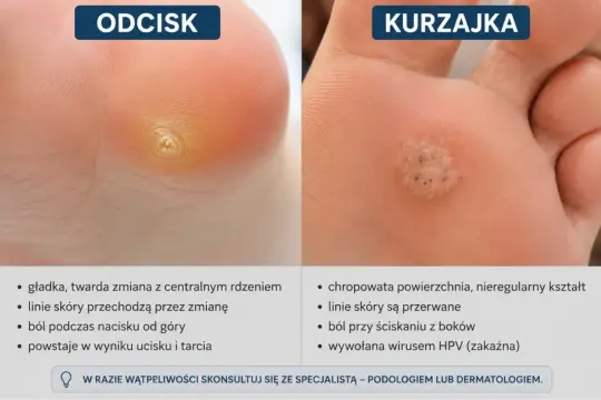 Porównanie kurzajki na stopie z odciskiem. Kurzajka jest chropowata, nieregularna, z przerwaniem linii skóry.