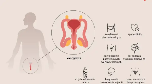 Objawy kandydozy u mężczyzn: swędzenie i pieczenie odbytu, ból podczas stosunku, zaczerwienienie narządów płciowych.