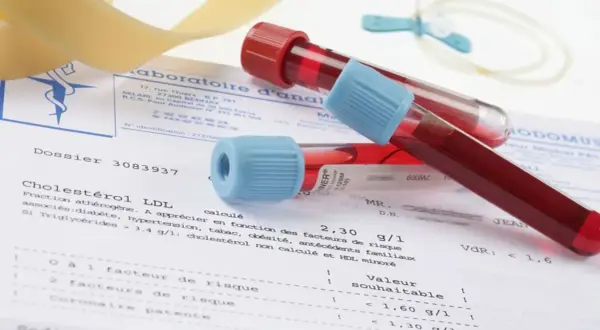 Próbki krwi w probówkach leżą na wynikach badań, gdzie widnieje m.in. "Cholestérol LDL". Badanie to pomaga ocenić ryzyko chorób serca, a jego wyniki są kluczowe, by zrozumieć, crp co to znaczy dla zdrowia.