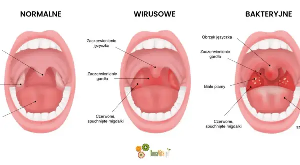 Ilustracja porównująca gardło zdrowe, zakażone wirusowo i bakteryjnie, z widocznymi migdałkami i językiem.