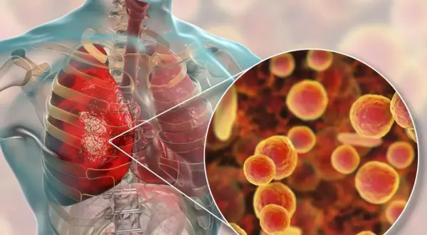 Ilustracja płuc człowieka z powiększeniem na bakterie Mycoplasma pneumoniae.