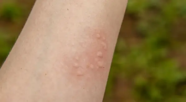 Na skórze ramienia widoczne są czerwone, wypukłe bąble, objaw pokrzywki alergicznej.