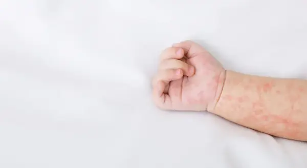 Różowa, nieswędząca wysypka u dziecka na białym tle.