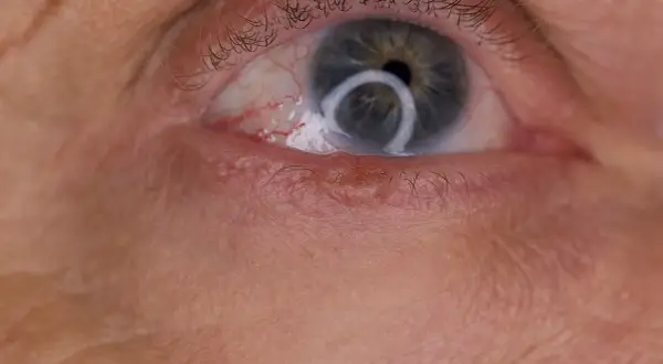 Widoczny kaszak na powiece dolnej, tuż pod rzęsami. Oko jest lekko zaczerwienione.