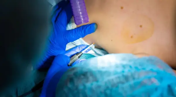 Chirurg w niebieskich rękawiczkach wykonuje biopsję skóry, pobierając próbkę do dalszych badań.