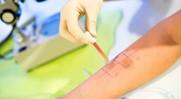 Test skórny w celu wykrycia uczulenia na wodę. Ręka pacjenta z zaznaczonymi polami do testów, na które aplikowana jest substancja.