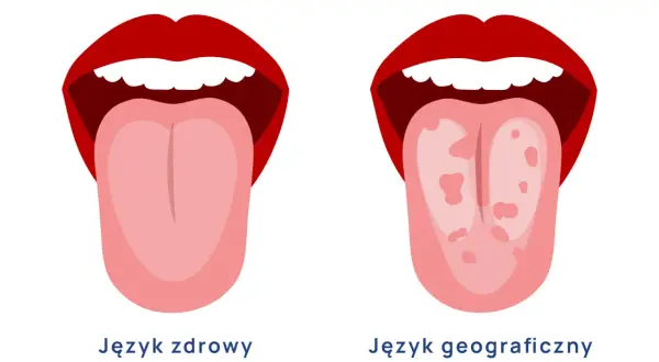 Dwa języki: zdrowy i z plamami, ilustracja porównawcza.