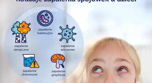 Grafika przedstawia rodzaje zapalenia spojówek u dzieci: alergiczne, bakteryjne, wirusowe, chemiczne i grzybicze. Widoczna jest też część twarzy dziecka z zaczerwienionym okiem.