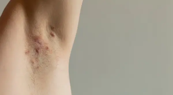Skóra pod pachą z widocznymi zmianami zapalnymi, które mogą wskazywać na trądzik odwrócony.