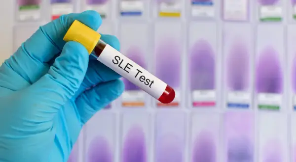 Ręka w niebieskiej rękawiczce trzyma probówkę z napisem "SLE Test", sugerującą diagnostykę tocznia. W tle widać rząd szkiełek mikroskopowych.