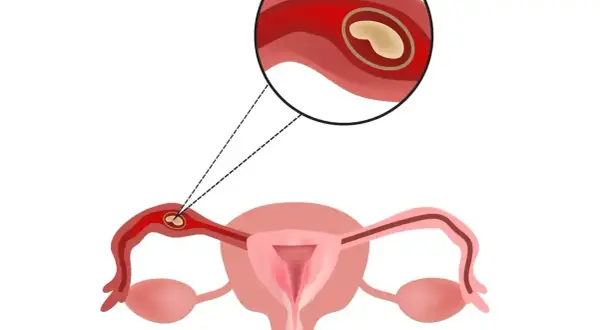 Ilustracja anatomiczna przedstawiająca ciążę pozamaciczną w jajowodzie.