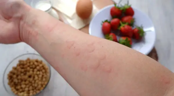 Ręka z zaczerwienionymi bąblami, objawy alergii pokarmowej. W tle truskawki, jajko i mleko.