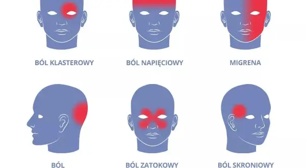Ilustracja przedstawia sześć schematycznych głów z zaznaczonymi obszarami bólu: klastrowy, napięciowy, migrena, szyjnopochodny, zatokowy, skroniowy.