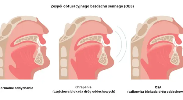 Ilustracja pokazuje przekrój gardła przy normalnym oddychaniu, chrapaniu (częściowa blokada) i bezdechu sennym (OSA, całkowita blokada). Domowe sposoby na bezdech senny mogą pomóc.