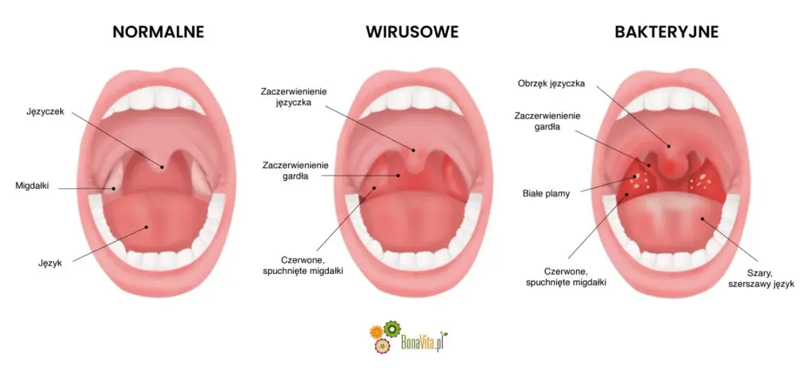 Ilustracja porównująca gardło zdrowe, zakażone wirusowo i bakteryjnie, z widocznymi migdałkami i językiem.